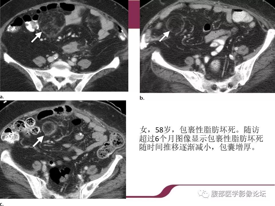 【病例】腹部脂肪坏死1例CT影像表现