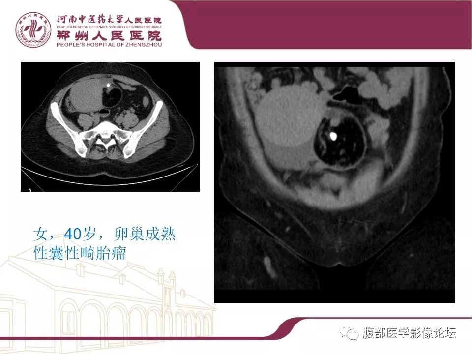 【病例】腹部脂肪坏死1例CT影像表现