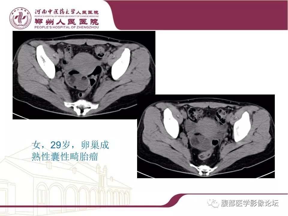【病例】腹部脂肪坏死1例CT影像表现