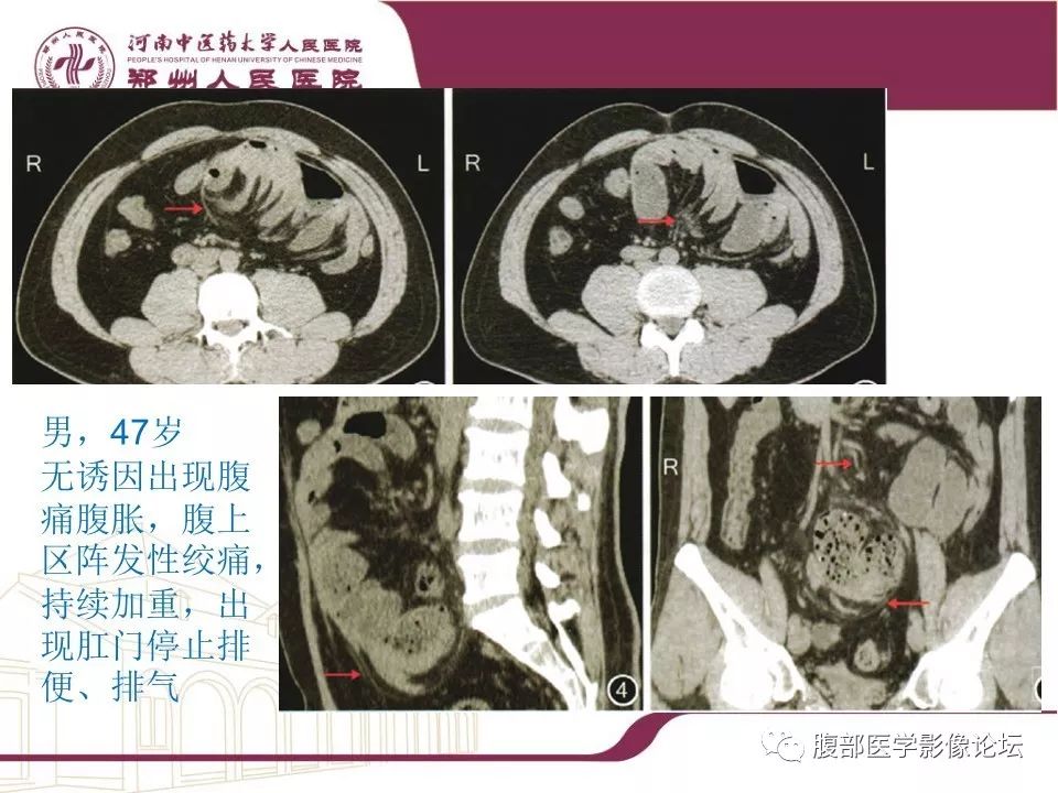 【病例】腹部脂肪坏死1例CT影像表现