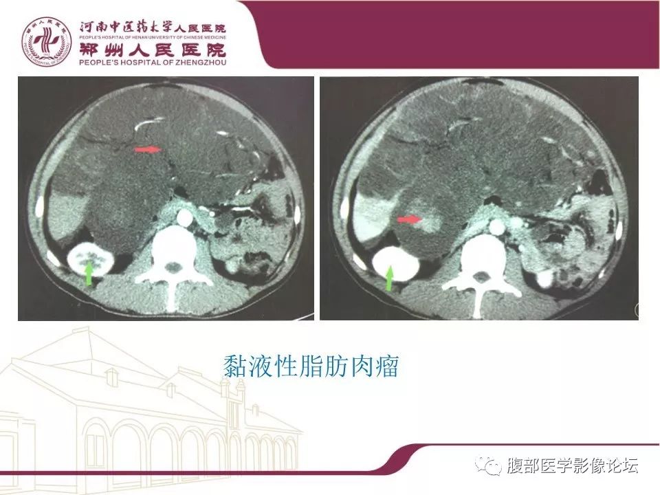 【病例】腹部脂肪坏死1例CT影像表现