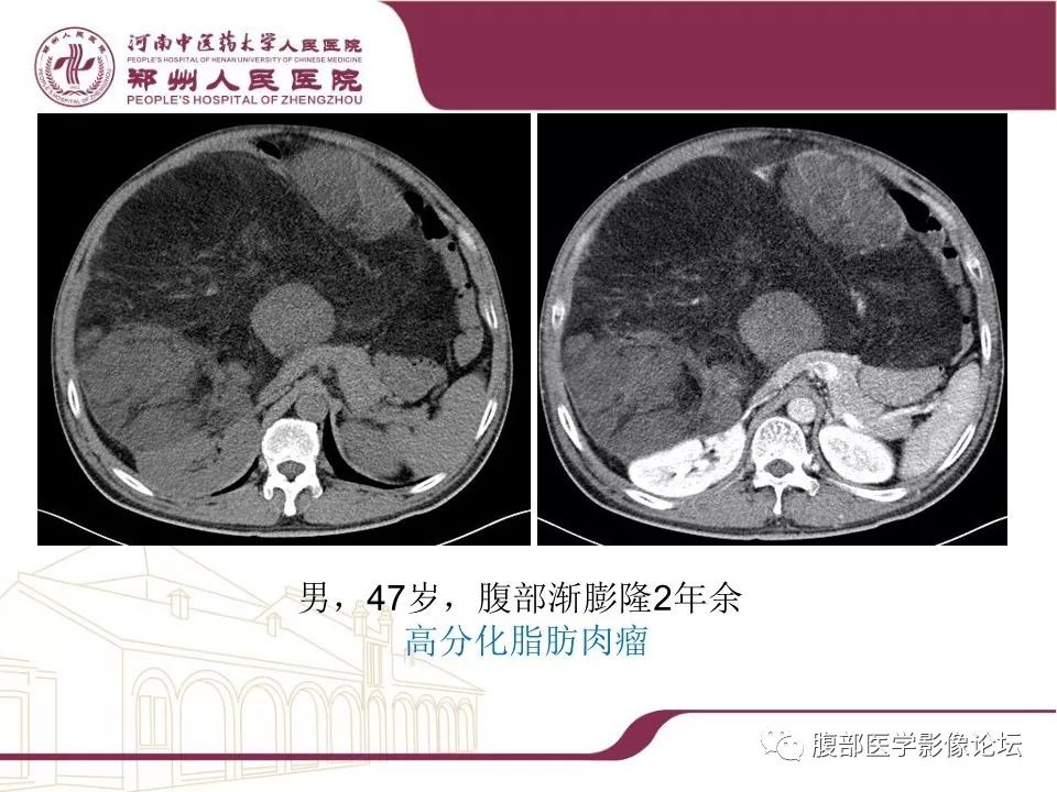 【病例】腹部脂肪坏死1例CT影像表现
