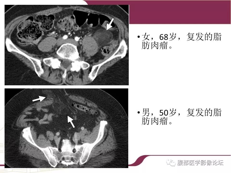 【病例】腹部脂肪坏死1例CT影像表现
