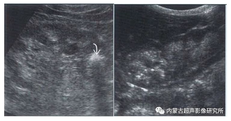 肾乳头坏死 肾乳头坏死