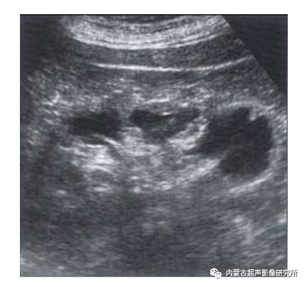 肾乳头坏死 肾乳头坏死
