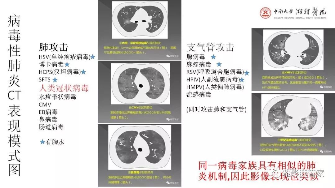 【PPT】快速掌握2019-nCoV新型冠状病毒肺炎CT影像学表现及报告规范