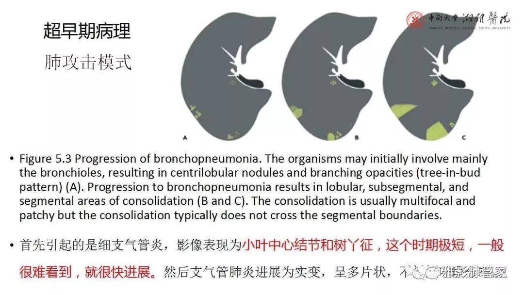 【PPT】快速掌握2019-nCoV新型冠状病毒肺炎CT影像学表现及报告规范
