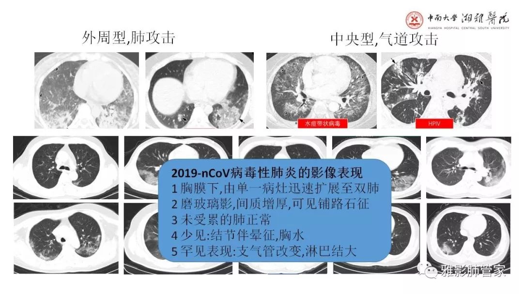 【PPT】快速掌握2019-nCoV新型冠状病毒肺炎CT影像学表现及报告规范