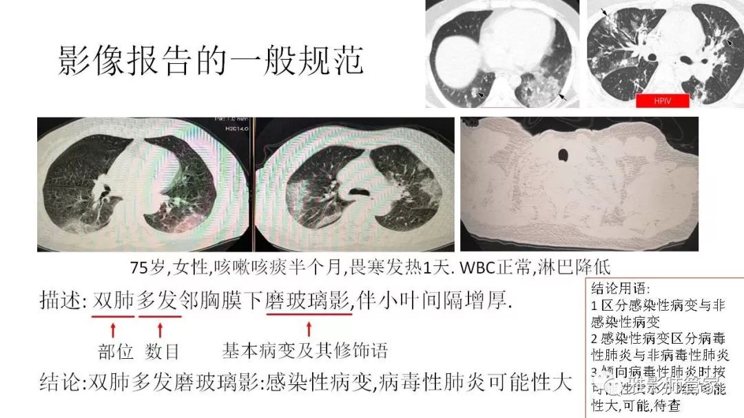 【PPT】快速掌握2019-nCoV新型冠状病毒肺炎CT影像学表现及报告规范