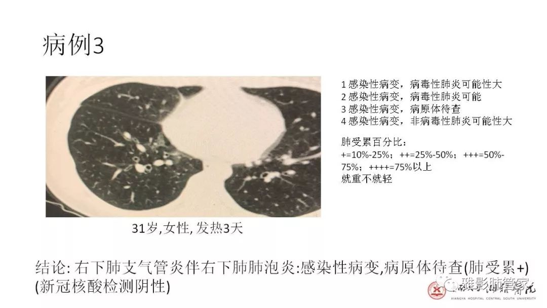【PPT】快速掌握2019-nCoV新型冠状病毒肺炎CT影像学表现及报告规范