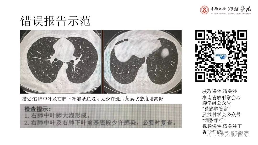 【PPT】快速掌握2019-nCoV新型冠状病毒肺炎CT影像学表现及报告规范