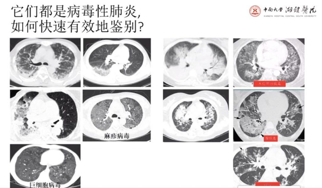 4次核酸检测阴性，新冠肺炎CT表现的 5 个特点请牢记
