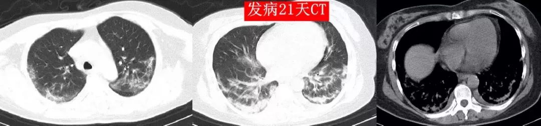 4次核酸检测阴性,新冠肺炎CT表现的 5 个特点请牢记 4次核酸检测阴性,新冠肺炎CT表现的 5 个特点请牢记