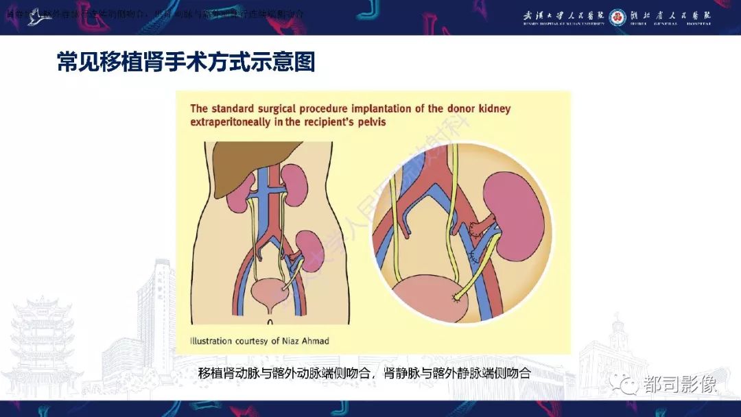 【PPT】肾移植术后并发症的CT和MRI表现