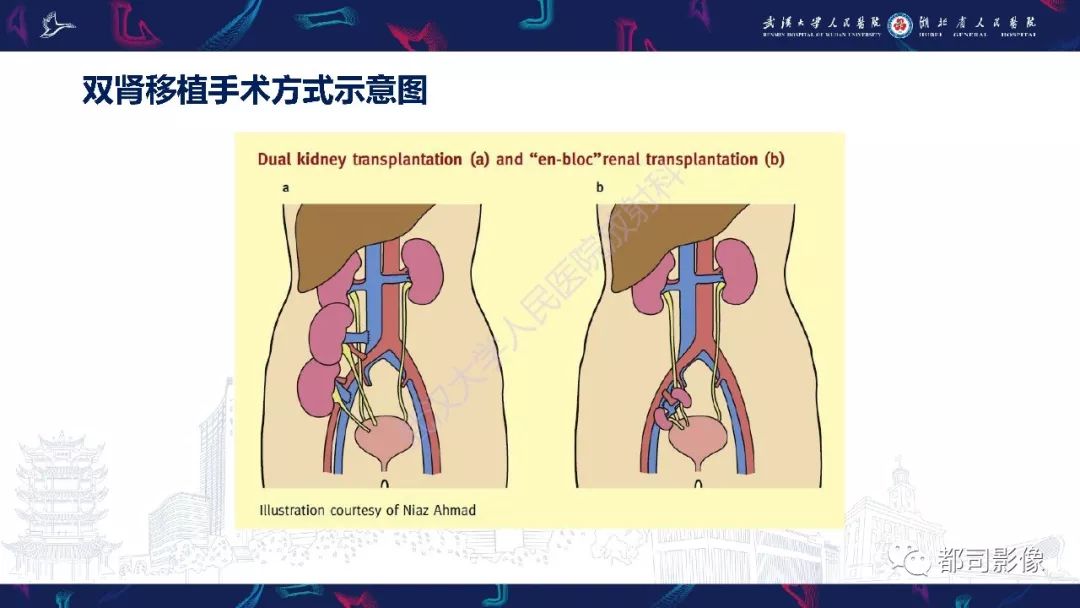 【PPT】肾移植术后并发症的CT和MRI表现