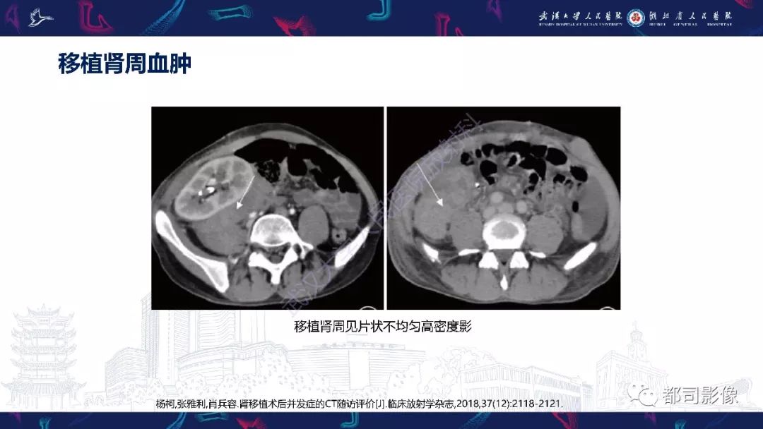 【PPT】肾移植术后并发症的CT和MRI表现