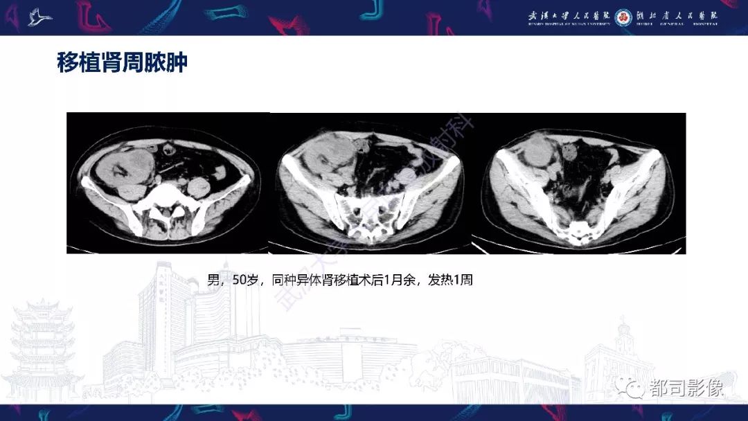 【PPT】肾移植术后并发症的CT和MRI表现
