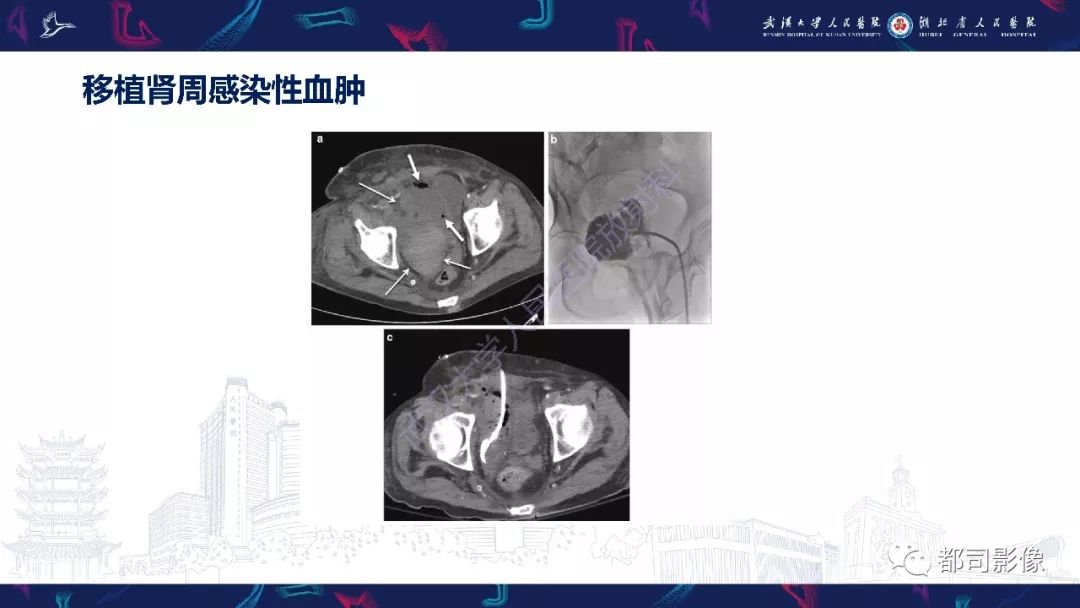 【PPT】肾移植术后并发症的CT和MRI表现