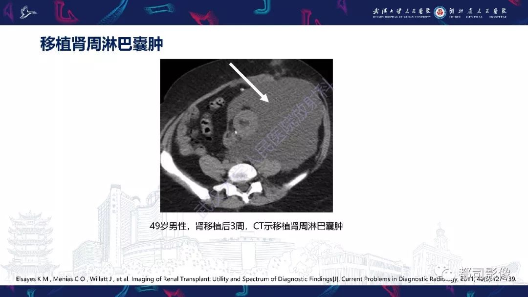【PPT】肾移植术后并发症的CT和MRI表现