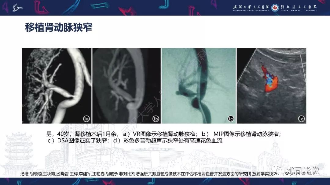 【PPT】肾移植术后并发症的CT和MRI表现