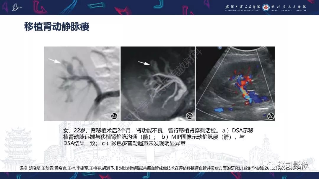 【PPT】肾移植术后并发症的CT和MRI表现