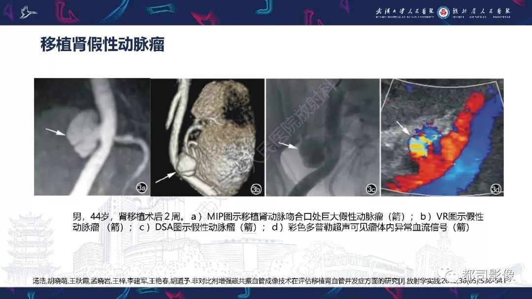 【PPT】肾移植术后并发症的CT和MRI表现