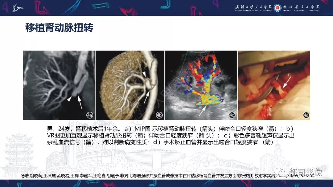 【PPT】肾移植术后并发症的CT和MRI表现