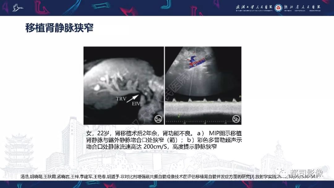 【PPT】肾移植术后并发症的CT和MRI表现