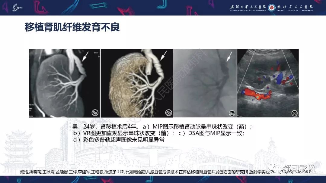 【PPT】肾移植术后并发症的CT和MRI表现