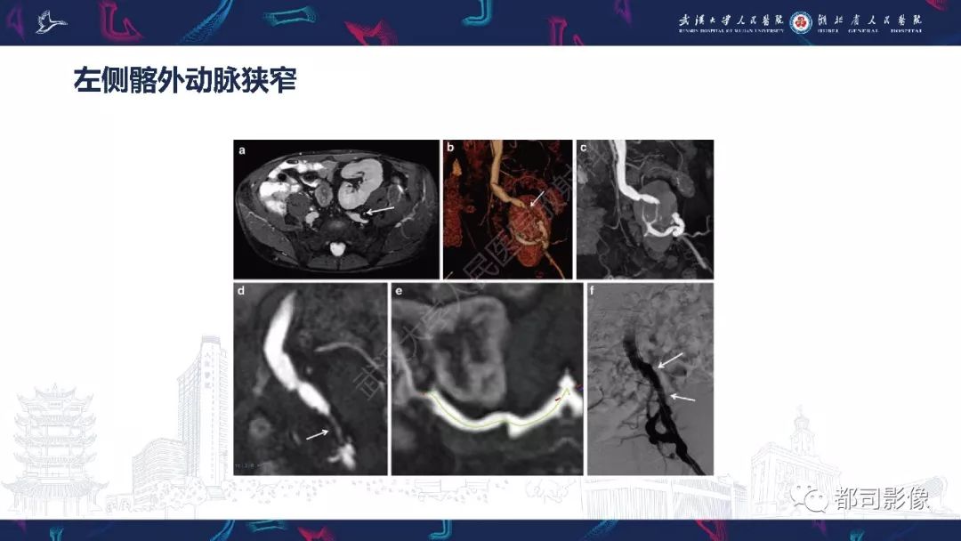 【PPT】肾移植术后并发症的CT和MRI表现