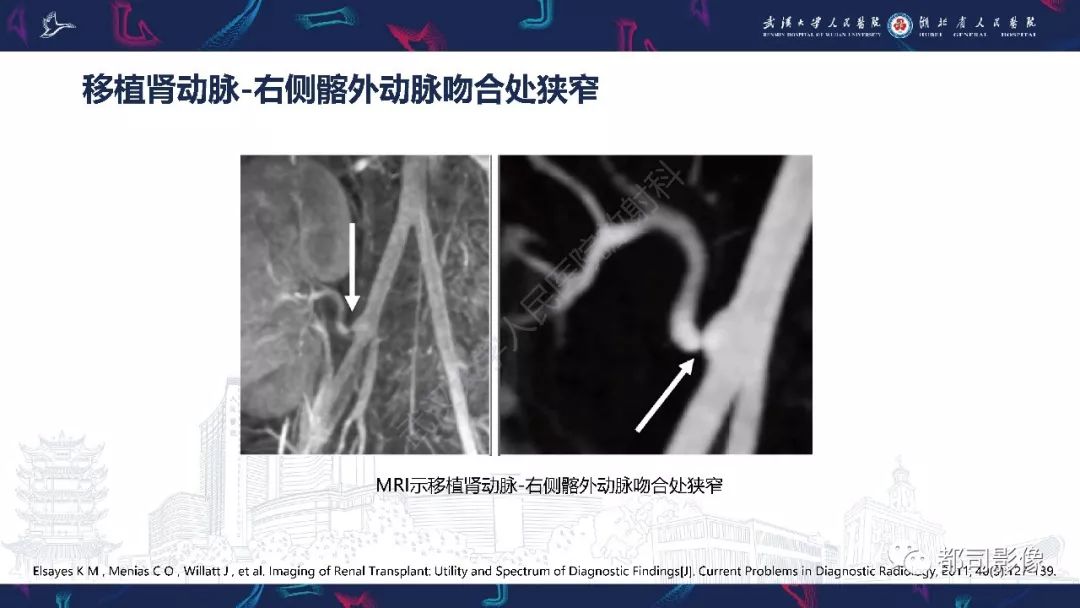【PPT】肾移植术后并发症的CT和MRI表现