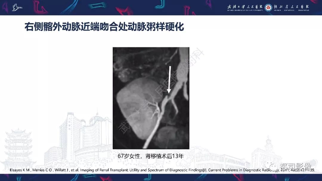 【PPT】肾移植术后并发症的CT和MRI表现