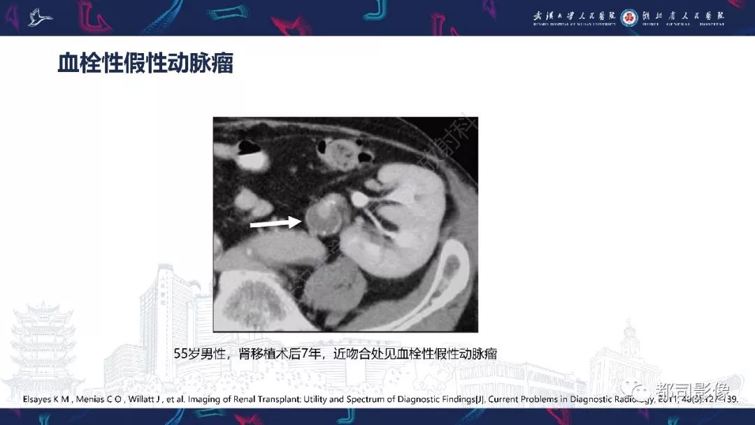 【PPT】肾移植术后并发症的CT和MRI表现