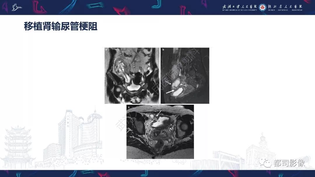 【PPT】肾移植术后并发症的CT和MRI表现