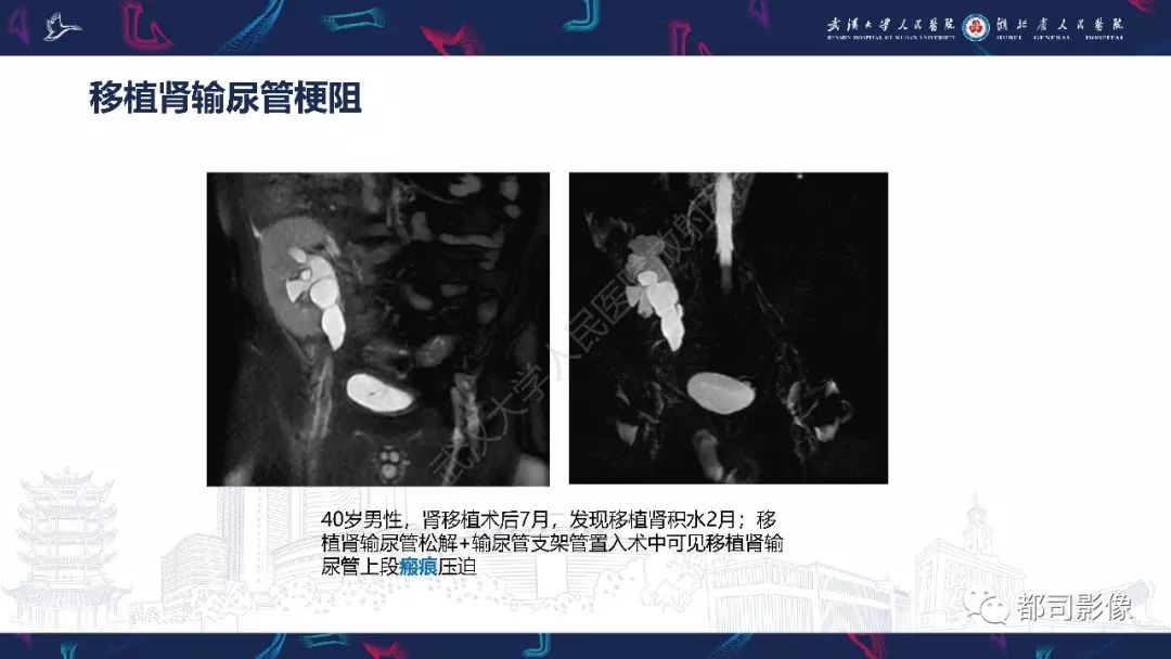 【PPT】肾移植术后并发症的CT和MRI表现