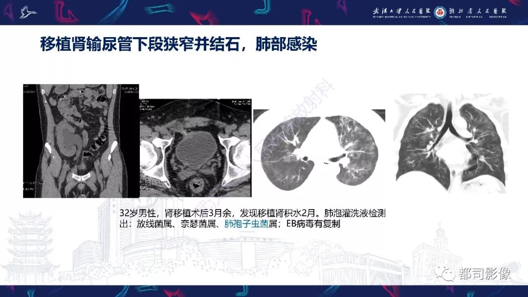 【PPT】肾移植术后并发症的CT和MRI表现