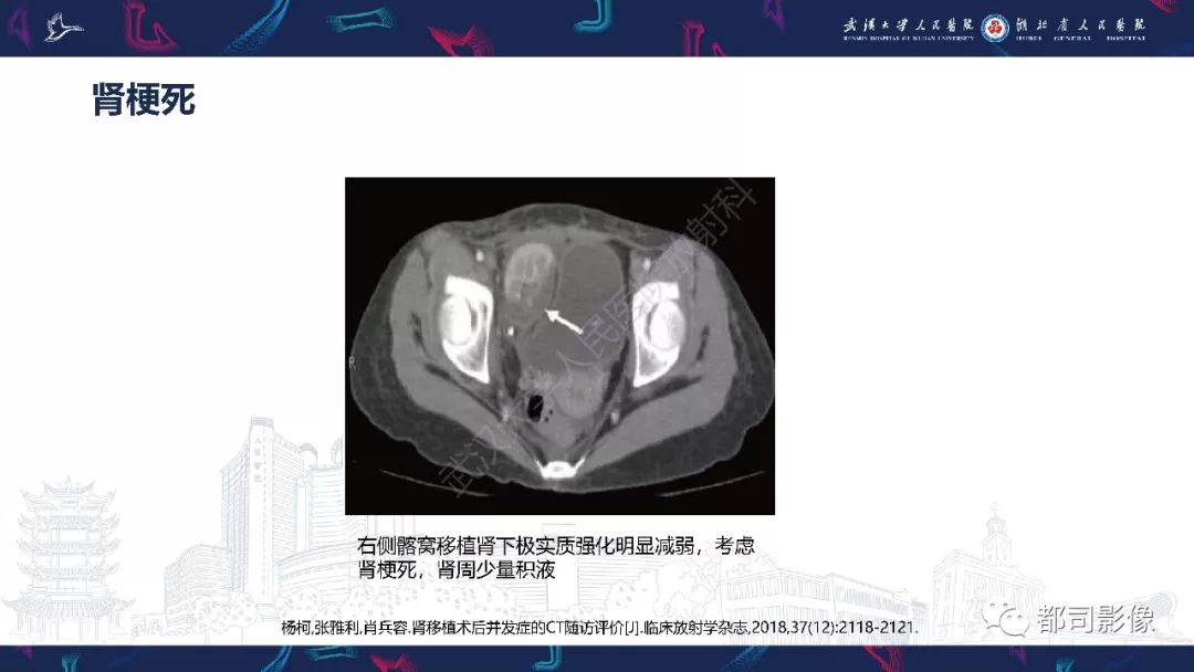 【PPT】肾移植术后并发症的CT和MRI表现