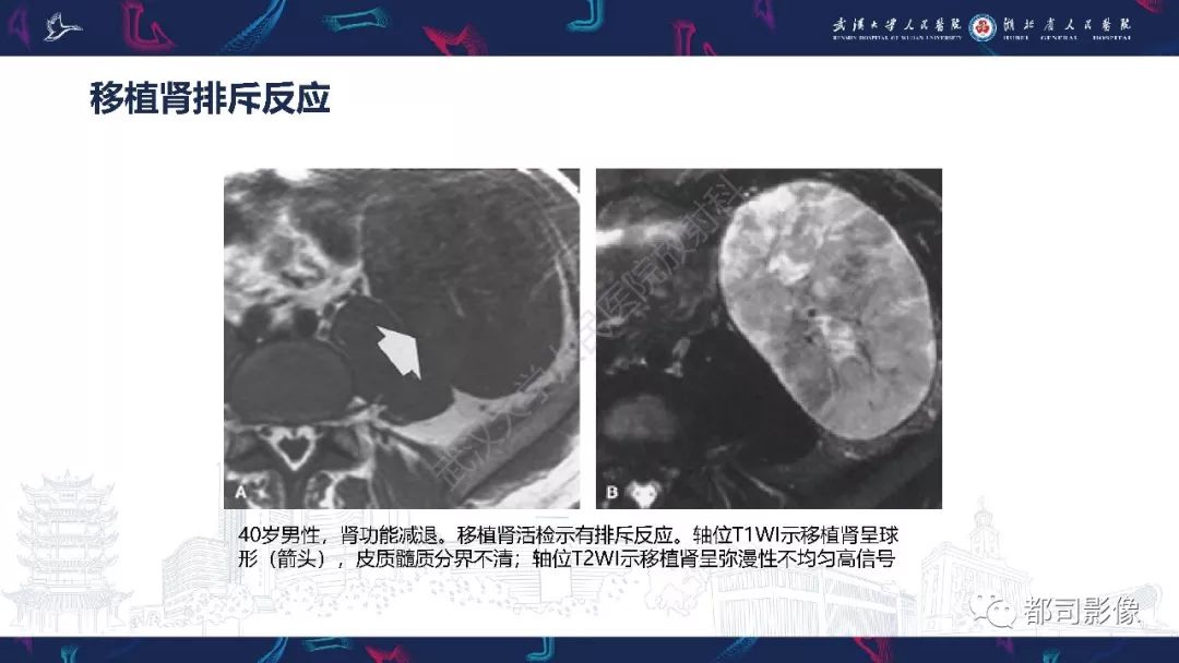 【PPT】肾移植术后并发症的CT和MRI表现
