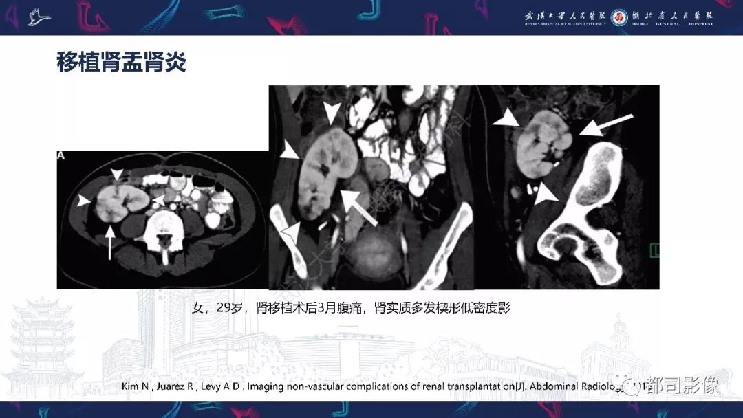 【PPT】肾移植术后并发症的CT和MRI表现
