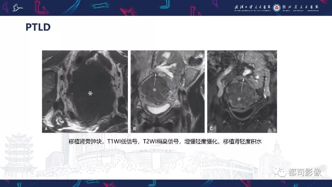 【PPT】肾移植术后并发症的CT和MRI表现