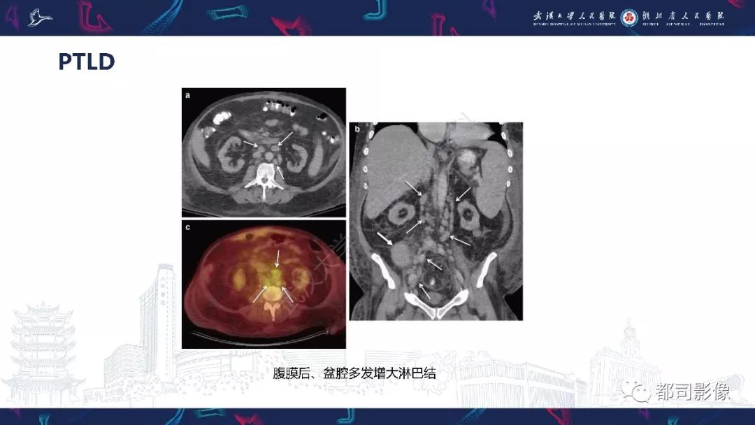 【PPT】肾移植术后并发症的CT和MRI表现