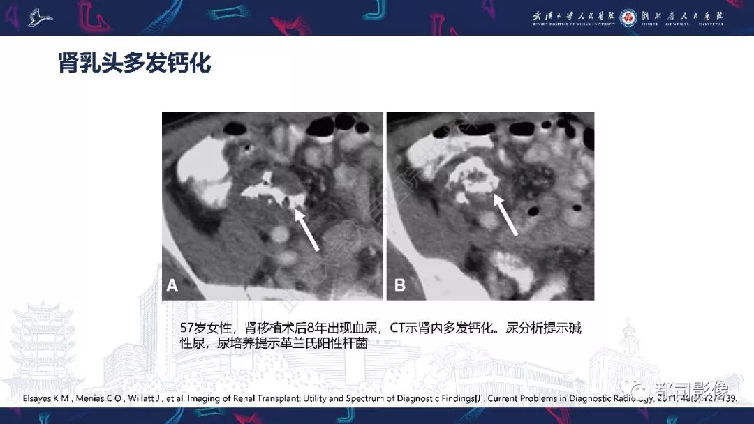 【PPT】肾移植术后并发症的CT和MRI表现