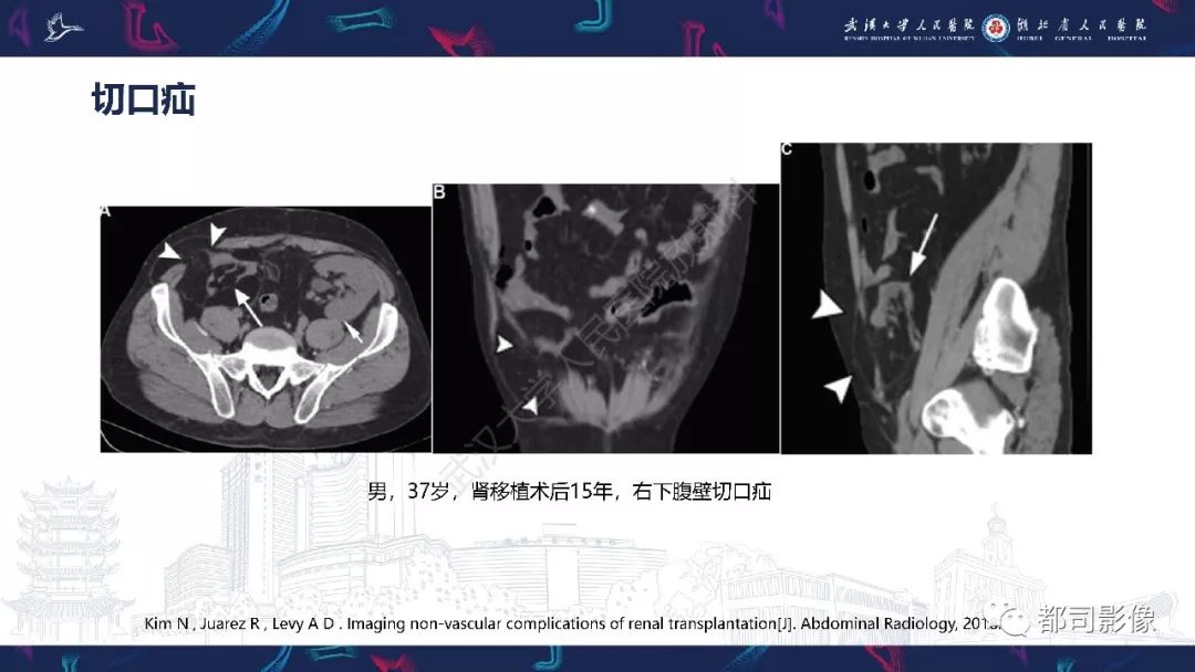 【PPT】肾移植术后并发症的CT和MRI表现