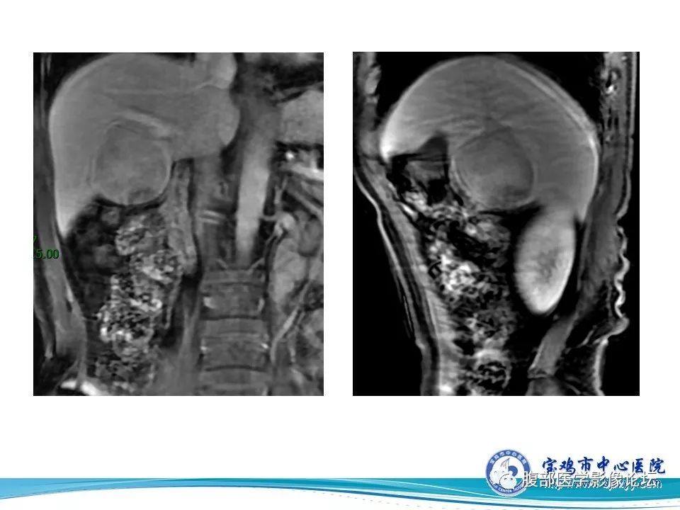 【病例】成人型肝母细胞瘤1例CT及MR
