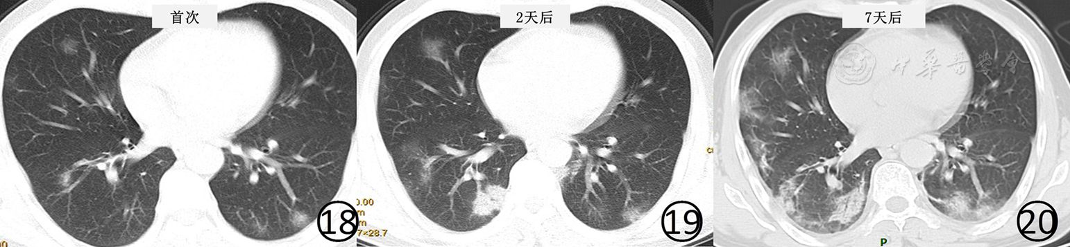新型冠状病毒肺炎的放射学诊断:中华医学会放射学分会专家推荐意见(第一版) 新型冠状病毒肺炎的放射学诊断:中华医学会放射学分会专家推荐意见(第一版)