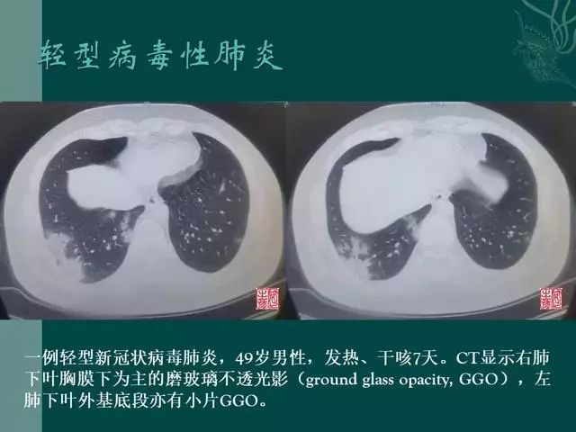 【PPT】病毒性肺炎概念与CT表现—新型冠状病毒肺炎