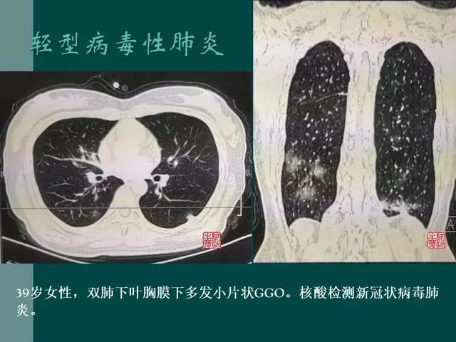 【PPT】病毒性肺炎概念与CT表现—新型冠状病毒肺炎