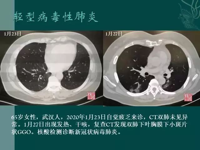 【PPT】病毒性肺炎概念与CT表现—新型冠状病毒肺炎