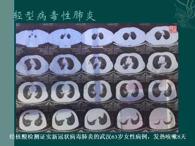 【PPT】病毒性肺炎概念与CT表现—新型冠状病毒肺炎
