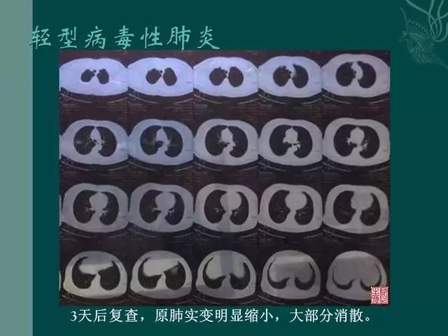 【PPT】病毒性肺炎概念与CT表现—新型冠状病毒肺炎